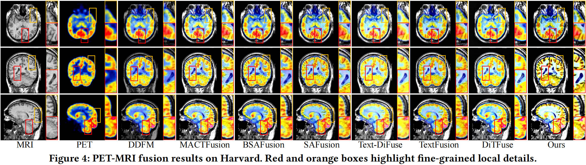 PET-MRI fusion results