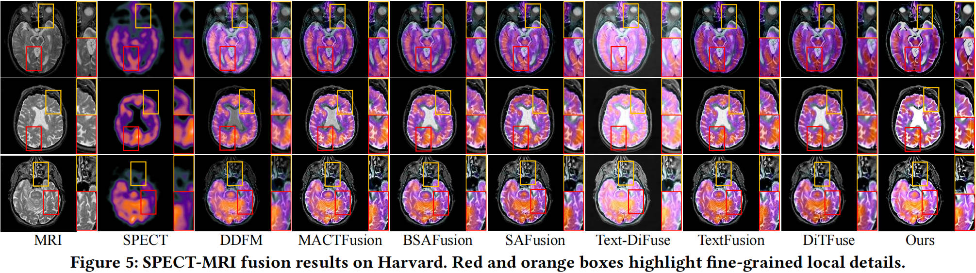 SPECT-MRI fusion results