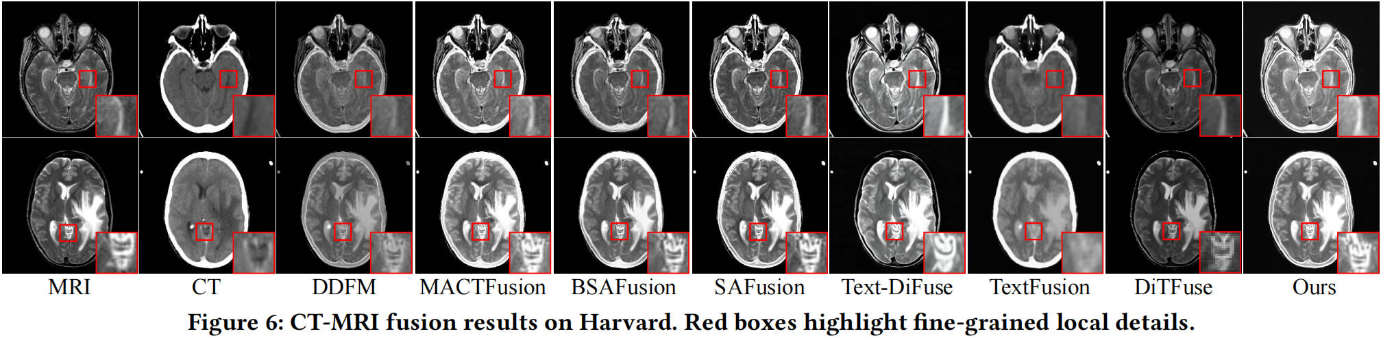 CT-MRI fusion results