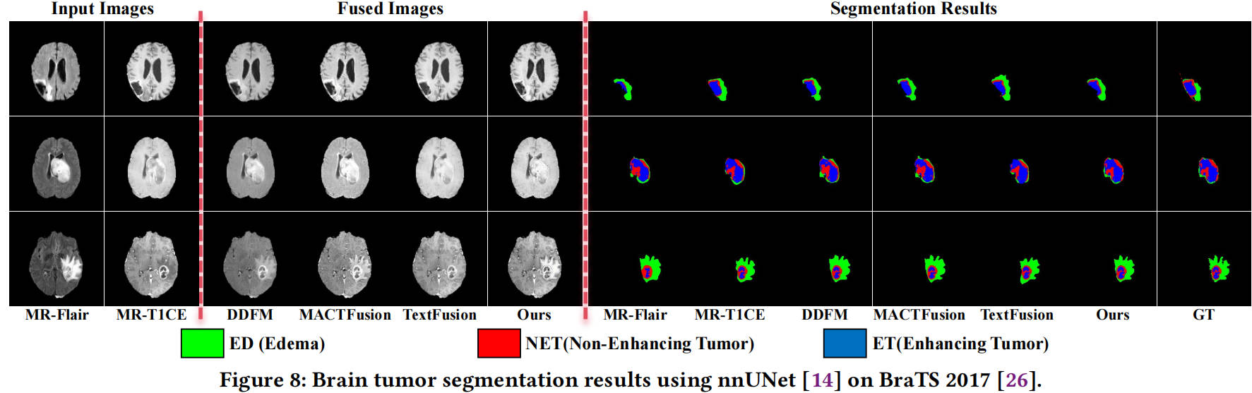Brain tumor segmentation